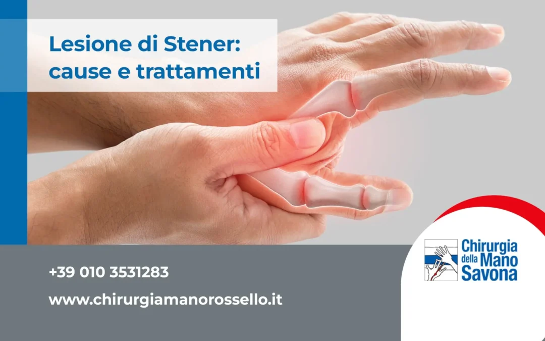 Lesione di Stener: cause e trattamenti